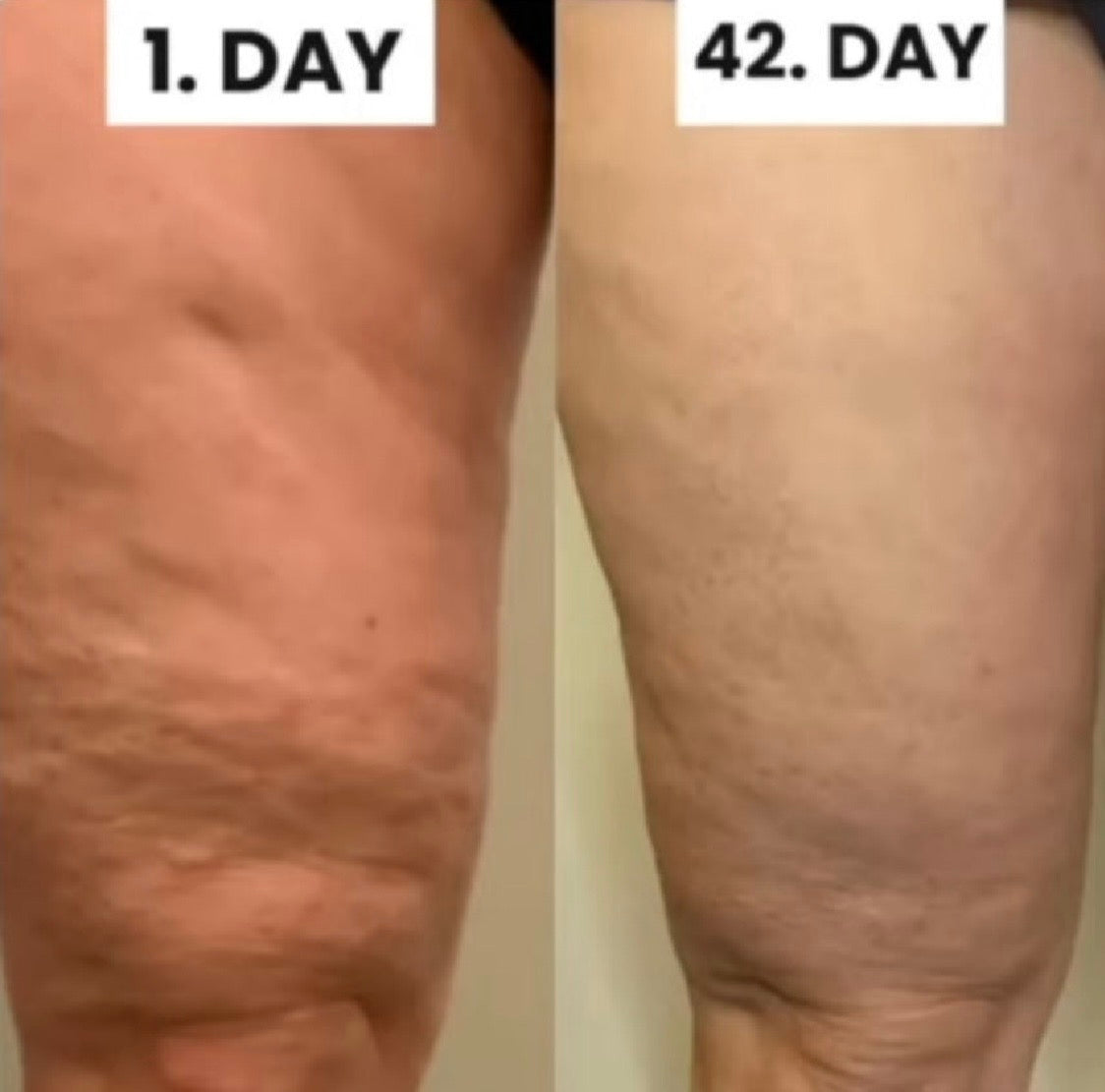 Vylora™ Cellulite Relief Kit