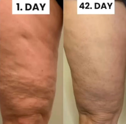 Vylora™ Cellulite Relief Kit